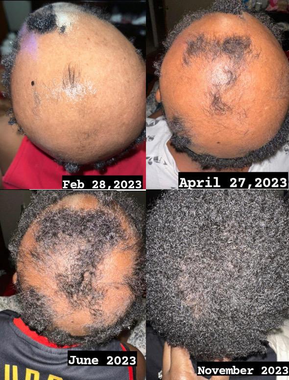 Extreme Scalp Stimulator Oil (Extra Strength Hair Serum)